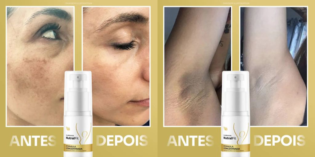 Antes e depois do uso de NutralFit - Clareador de Manchas: Resultados visíveis de pele mais uniforme e radiante após o tratamento. Ideal para clarear áreas como axilas, virilhas, cotovelos, olheiras e rosto, proporcionando uma aparência saudável e hidratada.